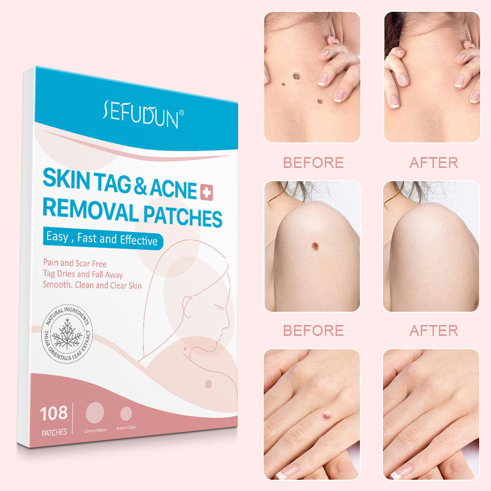 Skin Tag & Acne Removal Patches – 108 Stickers for Clear & Smooth Skin